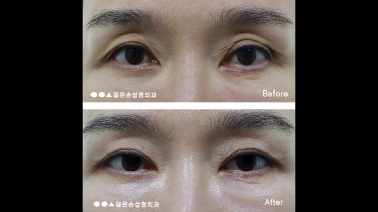  상안검하안검 자연스러운 결과
