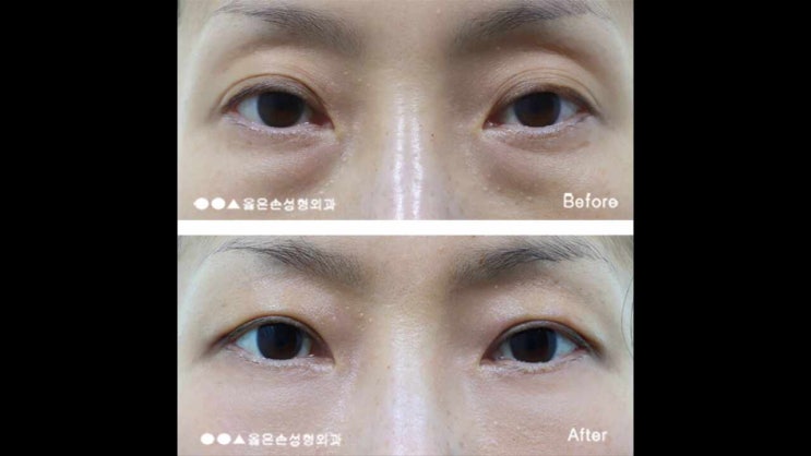  하안검수술후기 빠른회복의 결과
