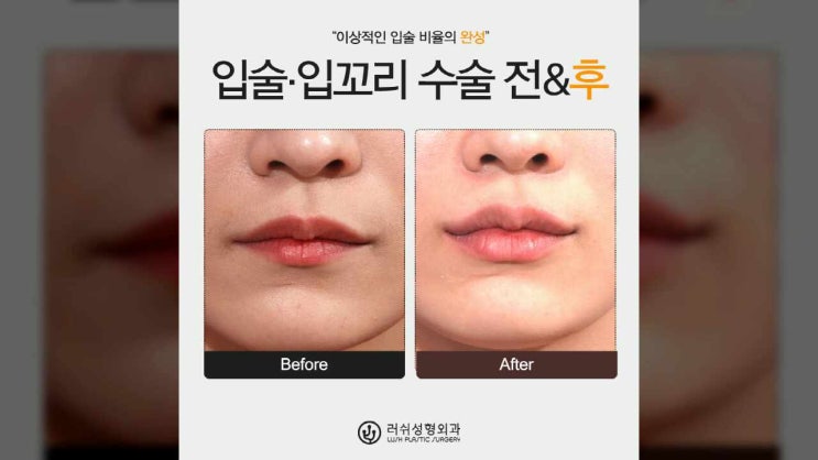 입술성형후기 자꾸 보고싶은 탐나는 입술·입꼬리! : 네이버 블로그