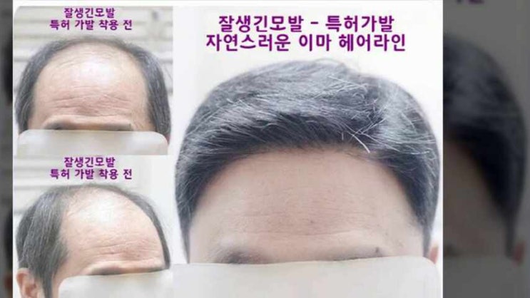  서울가발 인천 잘생긴모발연구소 홍대 영등포 남자부분맞춤장인