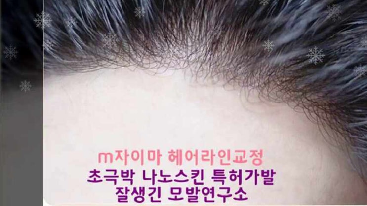  남자앞머리 가발샵 m자 탈모 엠자