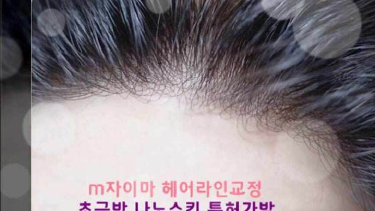  잠실가발 강남 전문점 인모100프로 탈모 남자 여자 앞머리