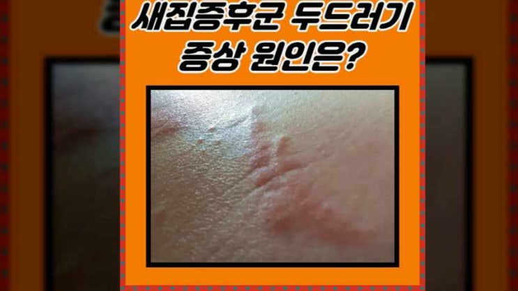  새집증후군두드러기 증상 원인이 모야?