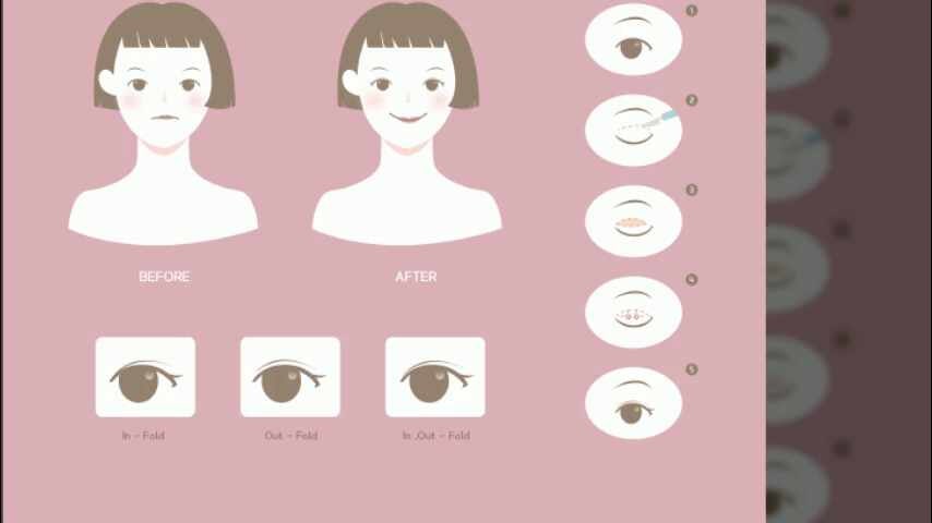 쌍꺼풀수술종류 나에게 맞는 방법을 선택해야