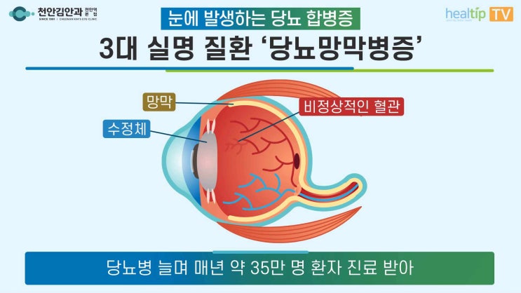 당뇨병 환자 실명 주범 ‘당뇨망막병증’ 시력 지키기 위해 알아야 할 ABC : 네이버 블로그