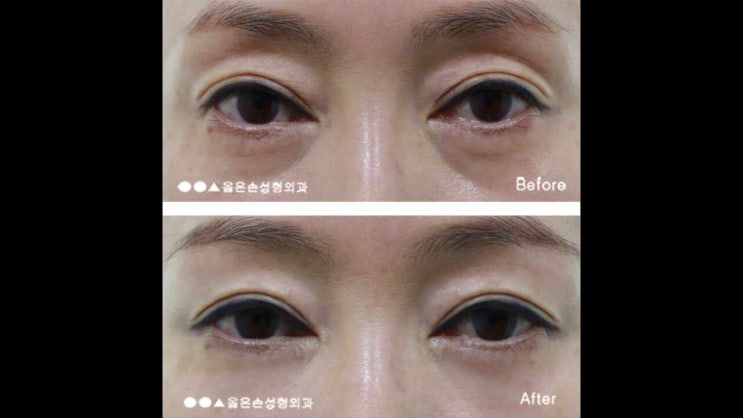  꺼진눈지방이식 원인과 해결방법