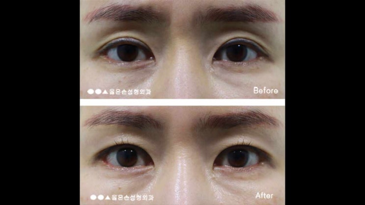  눈두덩이 꺼짐 증상별 해결방법