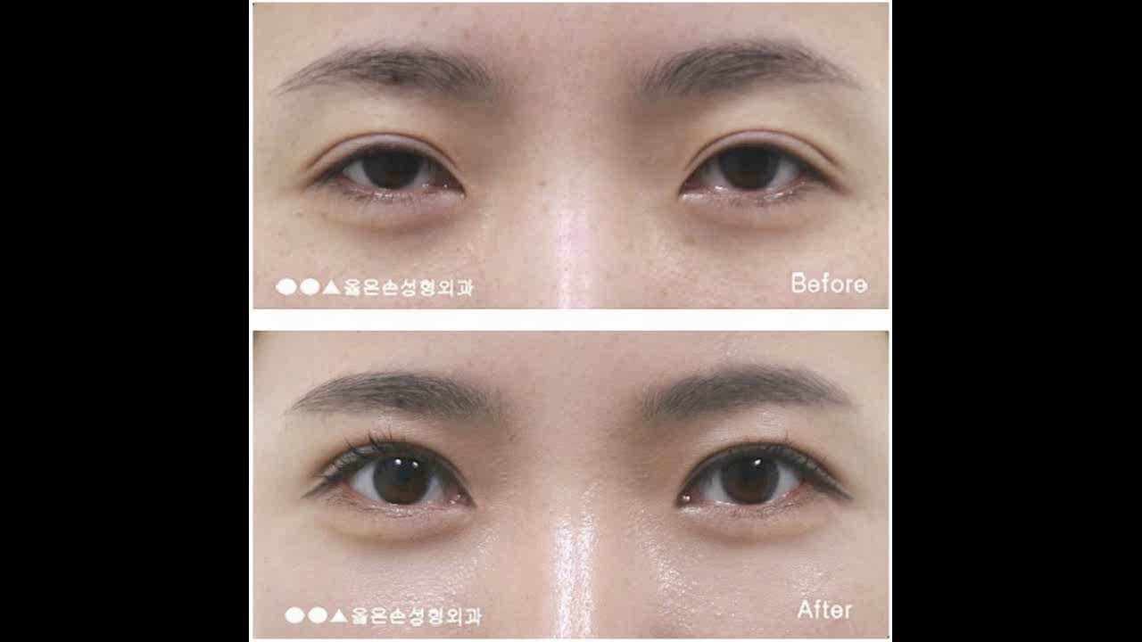 안검하수수술비용 결과의 차이