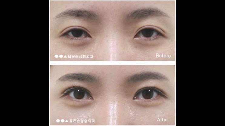  안검하수수술비용 결과의 차이
