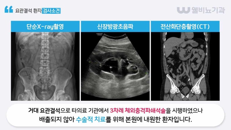 대전요로결석 요관내시경 결석 제거술 안내! : 네이버 블로그