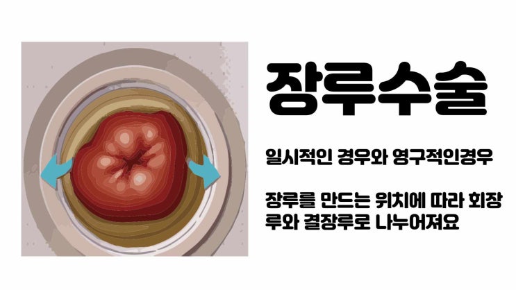 직장암 인공항문 장루 수술과 복원술 : 네이버 블로그