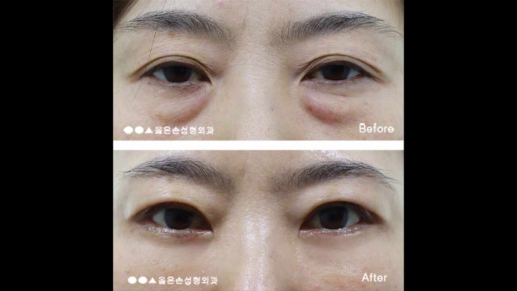  상안검수술비용 성공하는 길