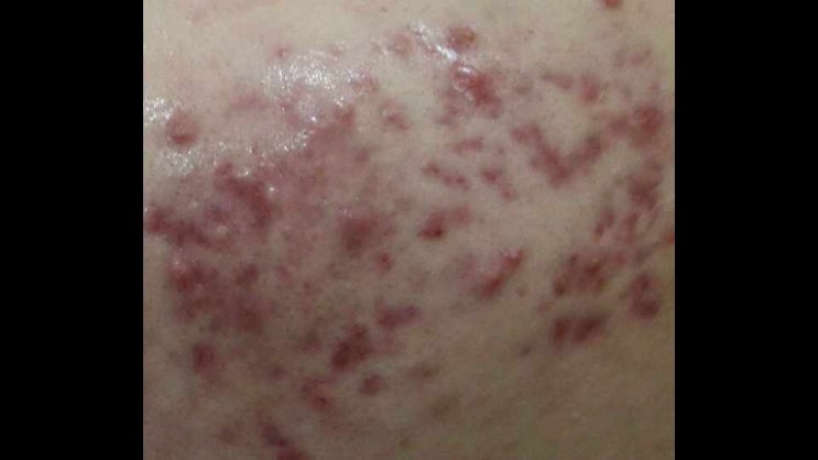  인천여드름치료 흉터를 없앨 수 있는 한방은