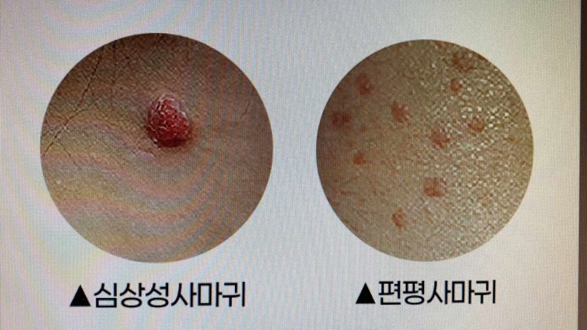 부산사마귀한의원 잘하는곳에서는 어떻게 사마귀를 제거할까