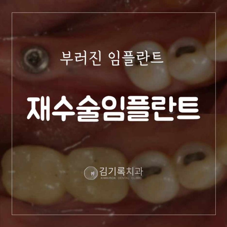 수원임플란트명의 타치과 임플란트 부러짐, 파절 재수술 임플란트 했어요!