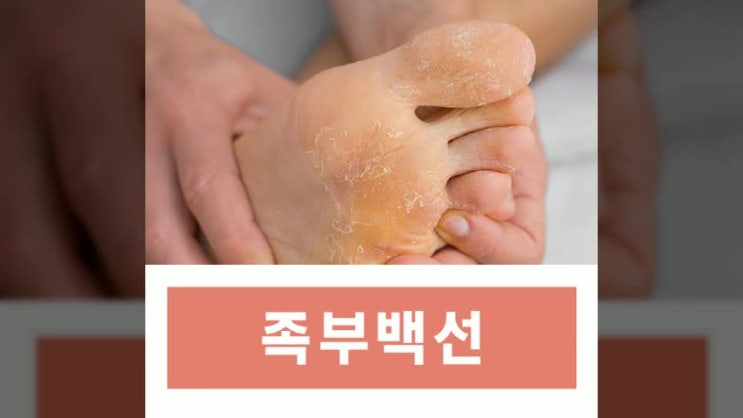 발 껍질 벗겨짐 족부백선 치료와 관리하는 법 : 네이버 블로그