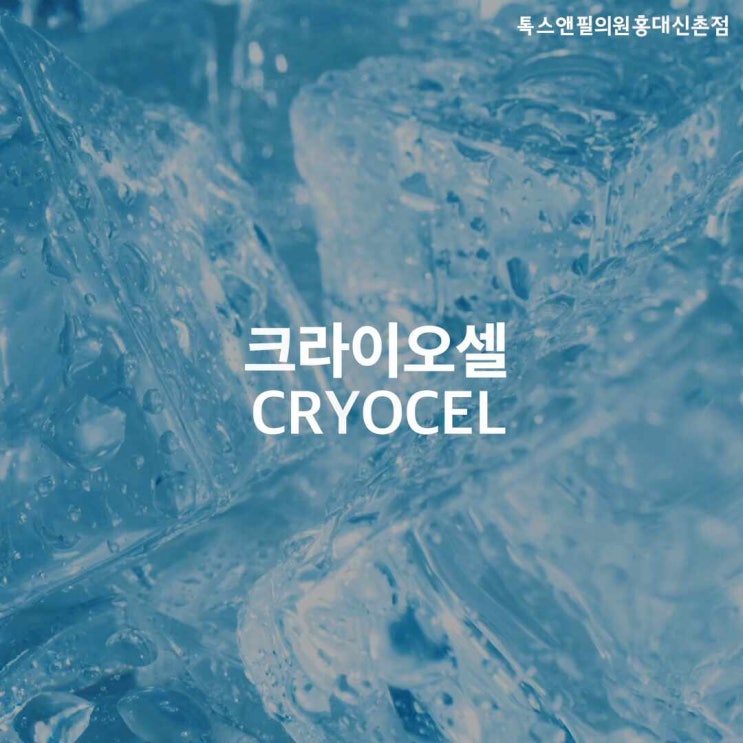  여름철피부관리 진정효과 뛰어난 냉동전기요법 크라이오셀