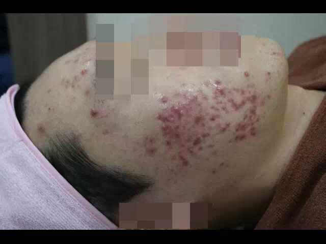  인천여드름피부과 한방처방되는 곳 알아본다면