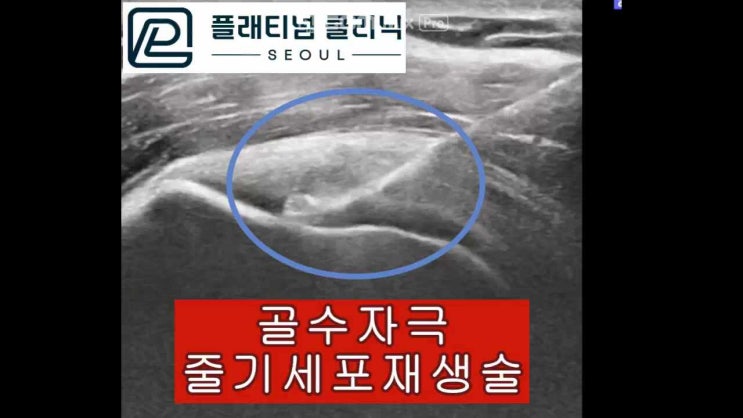 (플래티넘의원)회전근개부분파열:증식치료, 골수자극 줄기세포 재생술