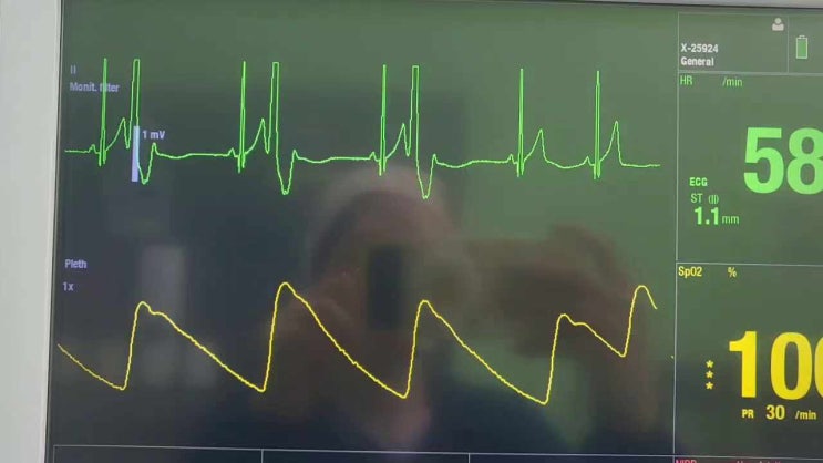  수술 중 조기 심실 수축(premature ventricular contraction) 이단맥 (bigeminy)은?