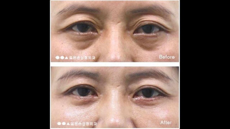  상안검수술비용 체크할 것들