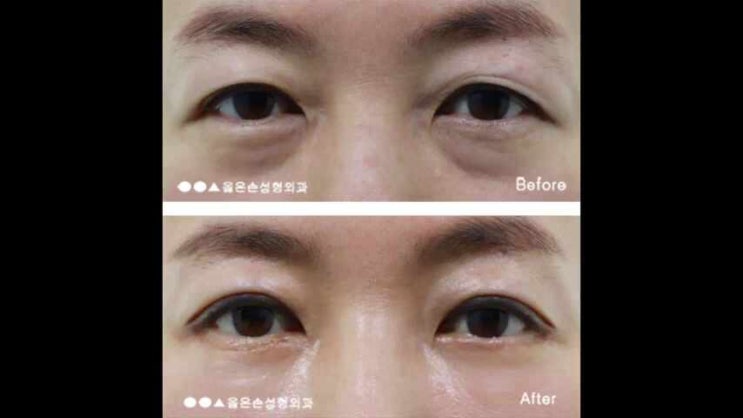  상안검수술회복기간 반드시 체크