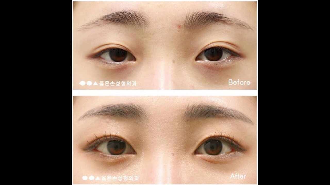 안검하수수술비용 옳은 접근방법