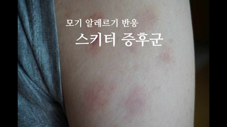 모기 알레르기 반응 스키터증후군 증상과 대처법 : 네이버 블로그