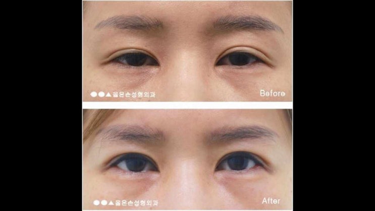  안검하수재수술 붓기와 회복기간