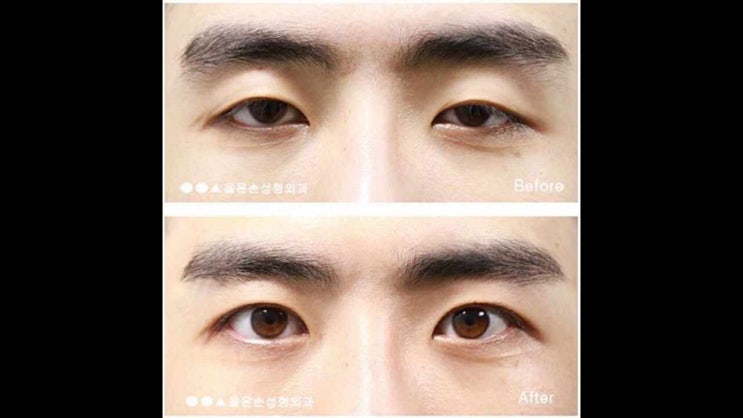  남자눈매교정가격 다름의 미학