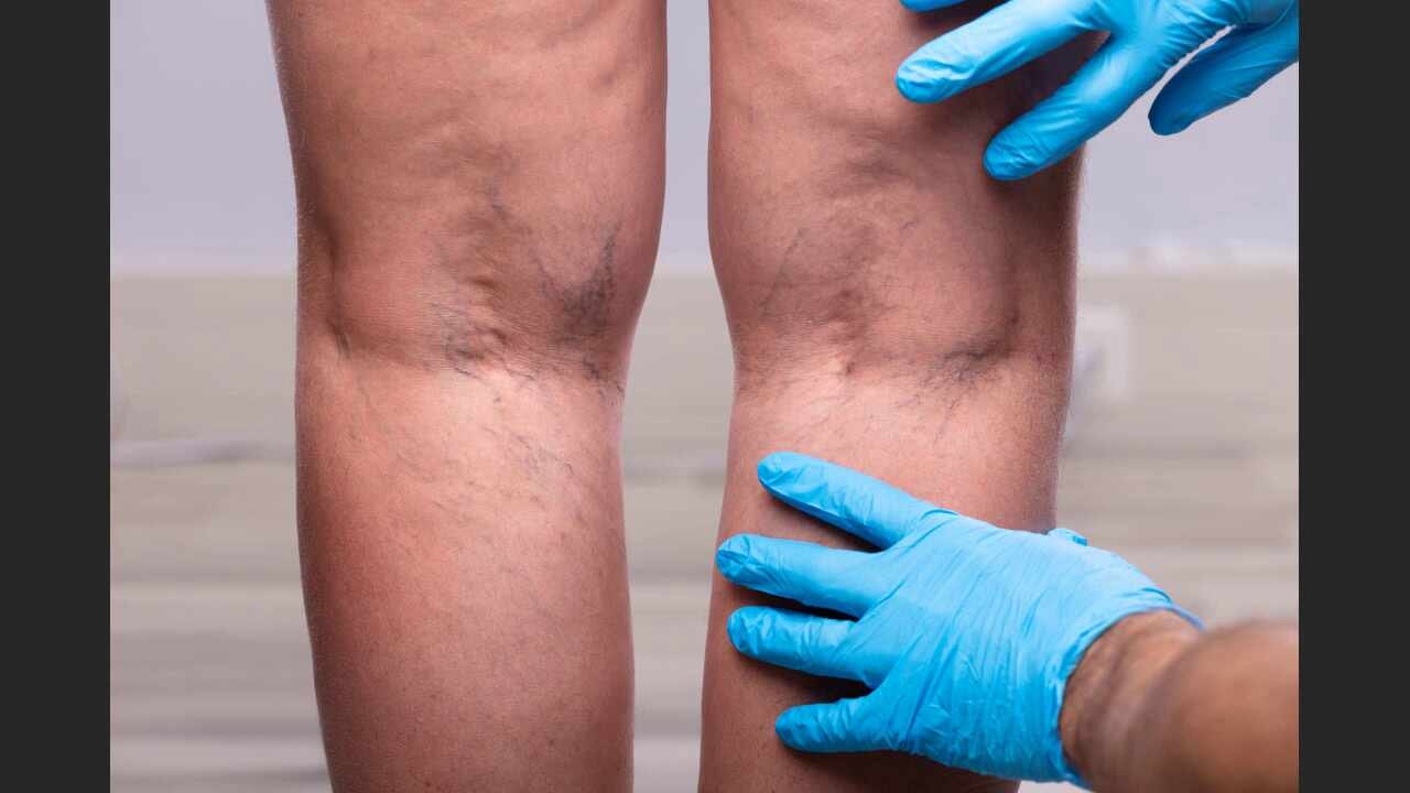 익산하지정맥 다양한 초기증상