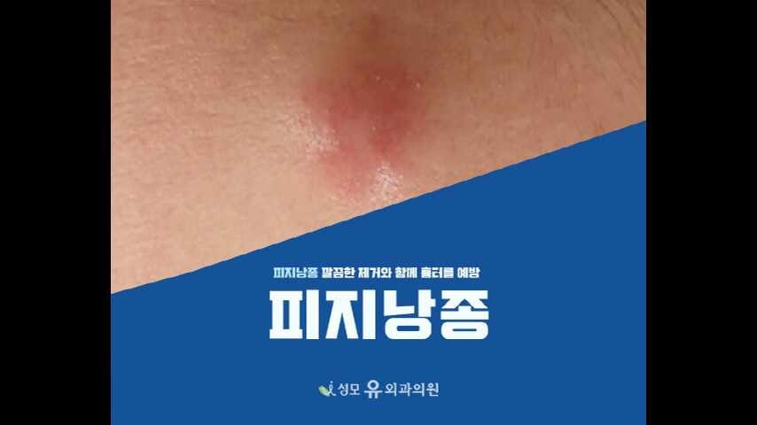 평택 외과 피지낭종 올바르게 제거하려면