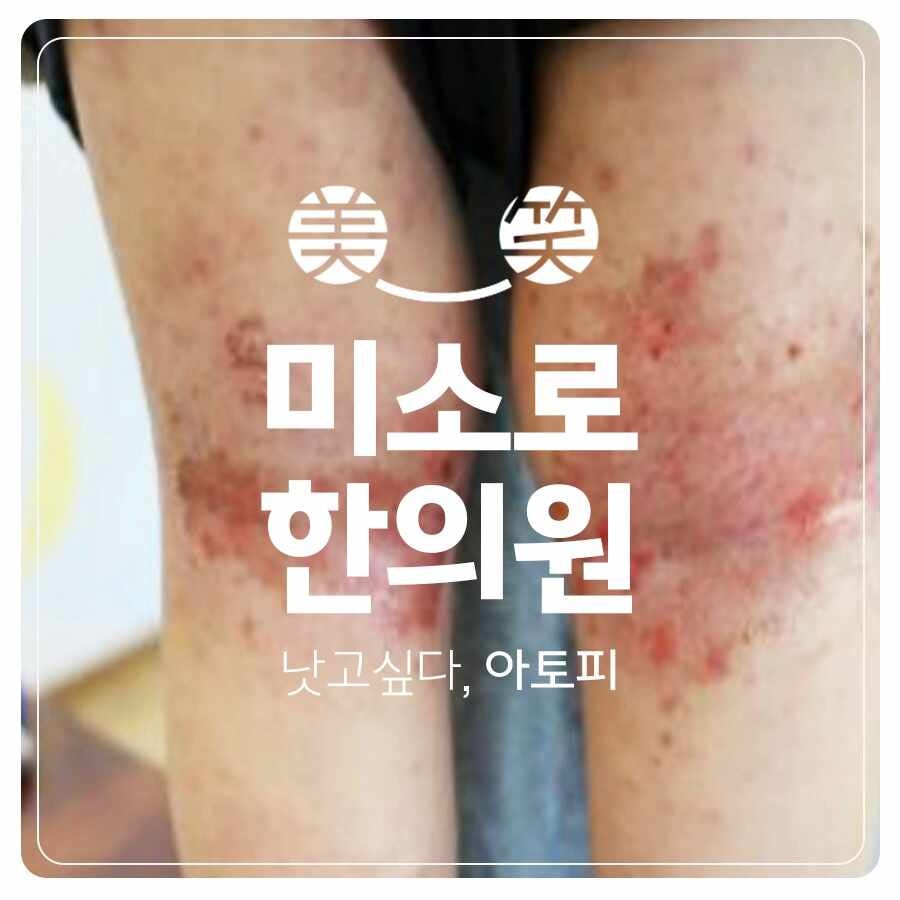 광주아토피한의원 치료 구체적으로 살펴보고