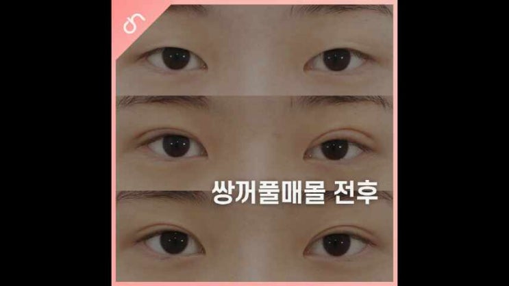 쌍꺼풀매몰전후 수술방법과 가능 여부는 : 네이버 블로그