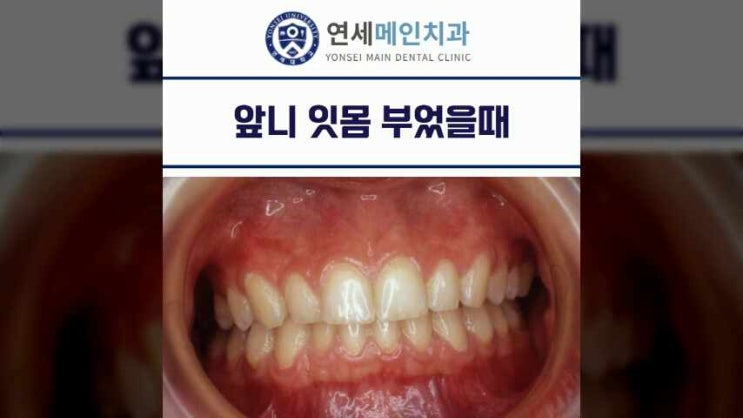  평촌역 치과 앞니 잇몸 부었을때 이유와 치료하는 방법은?