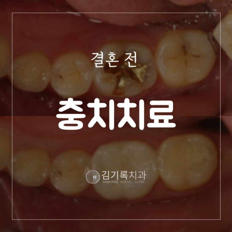 광교치과추천 결혼 전 구강검진 및 충치치료는 기본이죠