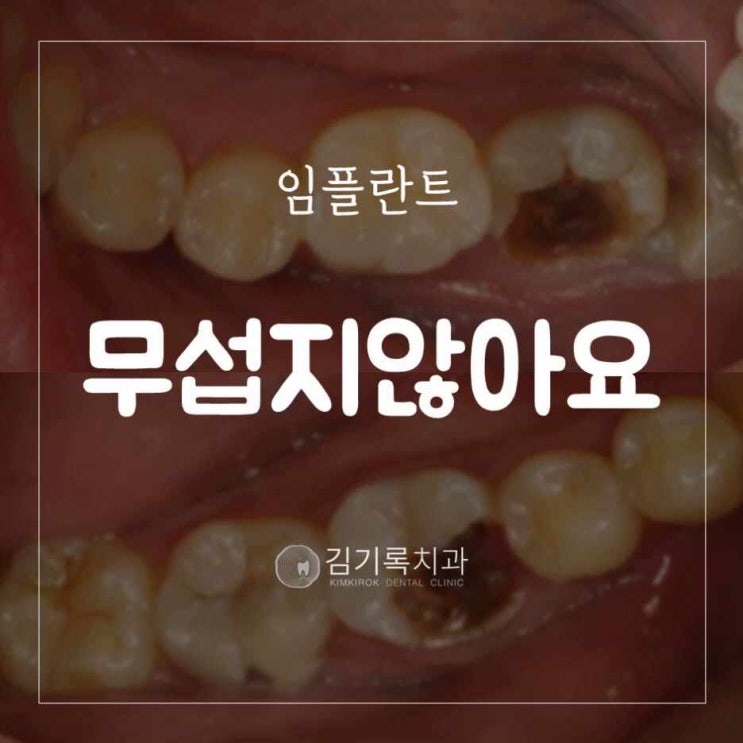 수원임플란트잘하는곳 임플란트 무섭지 않아요 치과공포 극복