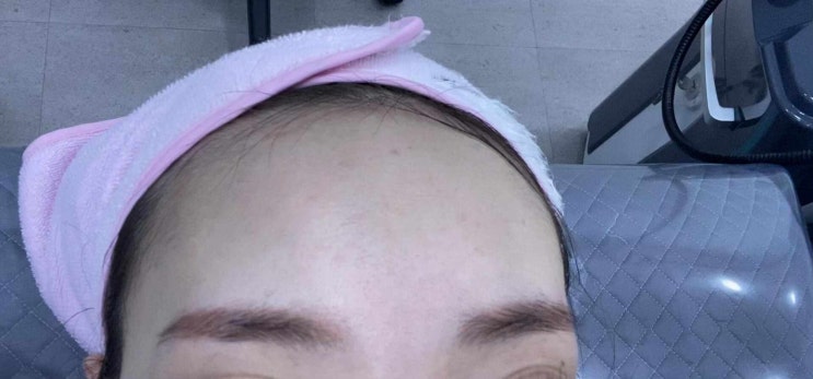 뷰티라운지강남 이마미간보톡스 효과시기 동영상비교