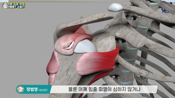 [청주회전근개파열] 어깨 통증을 유발하는 대표적 질환, 회전근개 파열의 원인과 치료 방법은? : 네이버 블로그