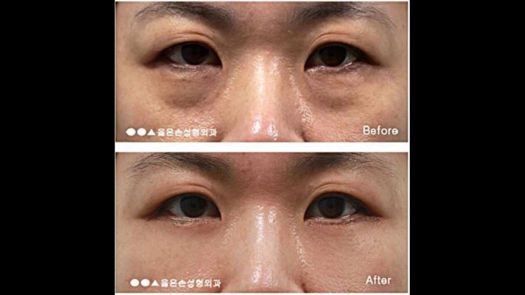  하안검재수술 기본을 지켜라