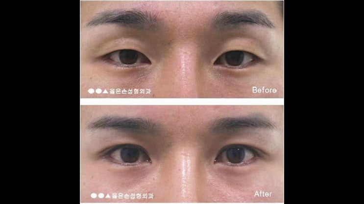  남자눈매교정가격 자연스러움이 중요하다