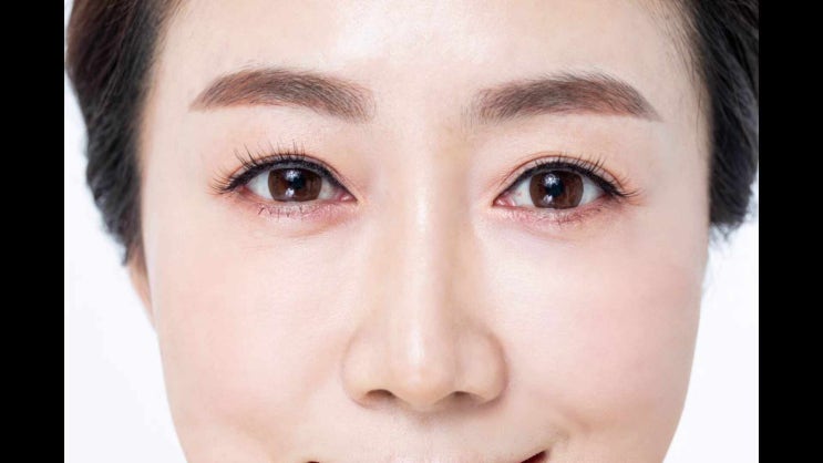 중년눈매교정 쌍꺼풀 라인을 잡아주는 3