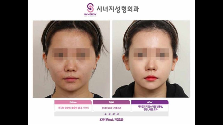  시너지성형외과 광대축소술가격,튀어나온 광대로 인한 고민 해결