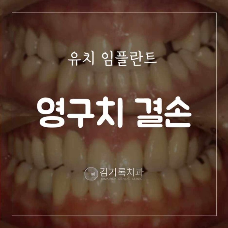 영통임플란트 영구치가 없어 유치 치아교정 후 앞니임플란트