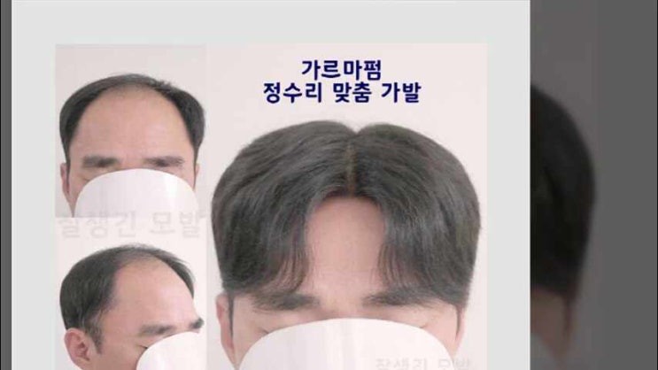  서울가발 남자 부분 맞춤 잘생긴모발 앞머리 m자 탈모 커버하고 정수리 원형