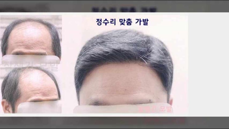  중년가발 60대 70대 남자 가발파는곳 정수리 항암