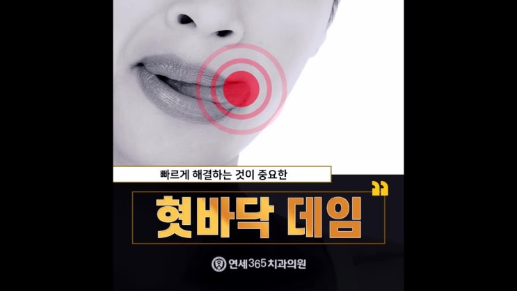  혓바닥 데임 빠르게 할 수 있는 방법은