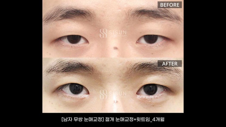 속쌍꺼풀수술로 무쌍처럼! : 네이버 블로그