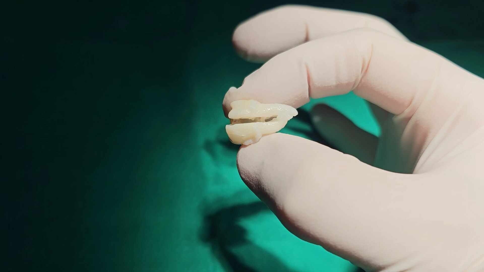 10대, 20대에 사랑니 발치 통증과 증상이 있었다면 편안하고 편안하게 주무세요.발치 10대, 20대에 사랑니 발치 통증과 증상이 있었다면 편안하고 편안하게 주무세요.발치