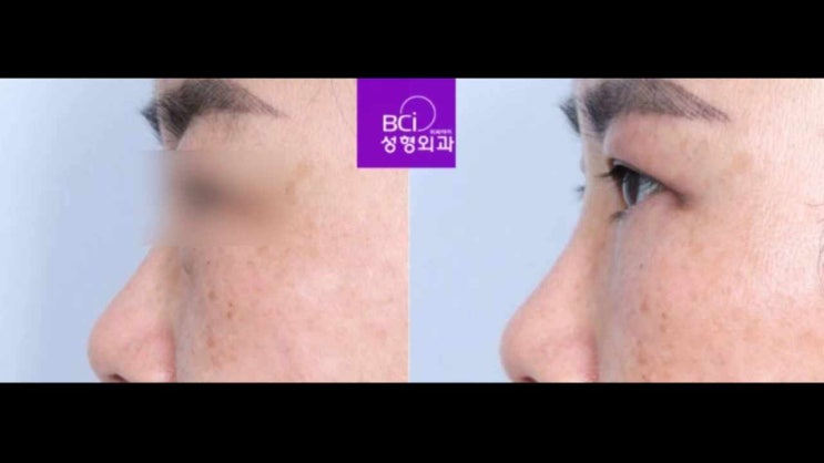 하안검수술흉터 얼마나 갈까? : 네이버 블로그